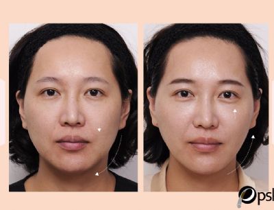 臉上的一線生機！「提‧美‧拉」線性拉提改善歲月在臉上的各種問題 - 相關案例